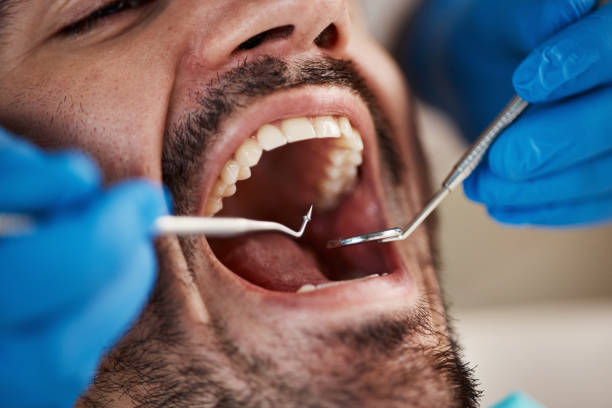 Best Emergency Gum Treatment in Troy, OH